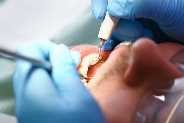 Best Emergency Dentist for Lost Fillings or Crowns in Lake Nacimiento, CA