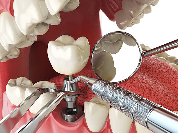 Best Broken or Cracked Tooth Emergency Dentist in Lake Nacimiento, CA
